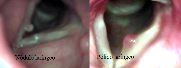 Nódulo y pólipo laringeos