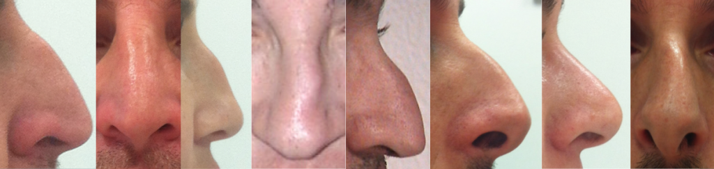 4 Cirugía pirámide nasal
